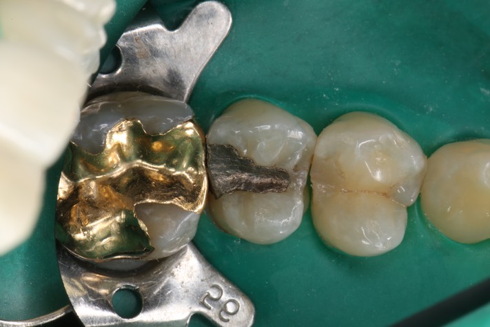 Mendel Sato #13 pre-op