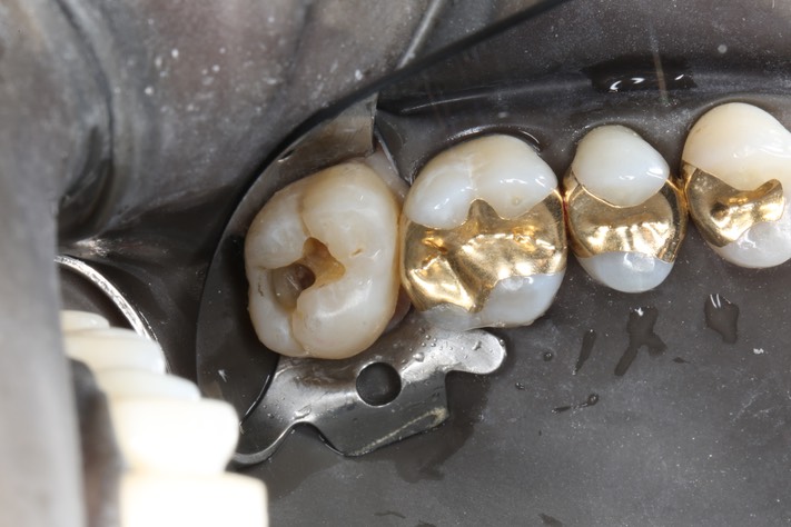 Ted Kanamori #15 amalgam removal