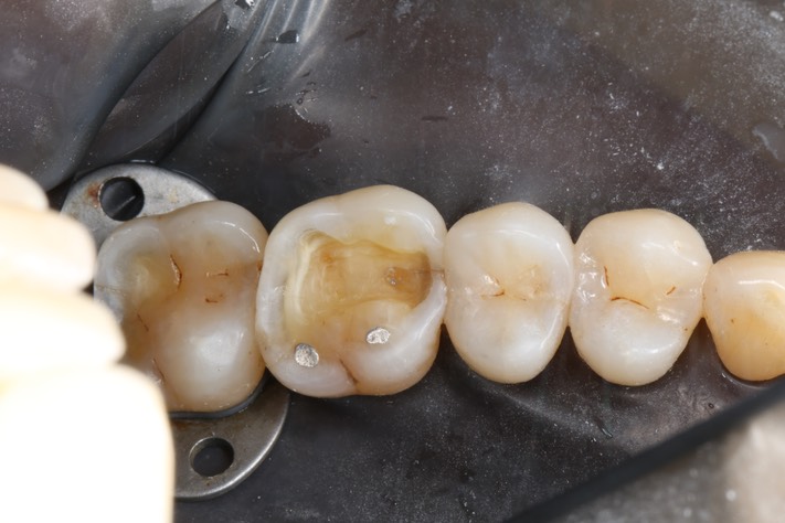 Russ Tabata #14 amalgam removal