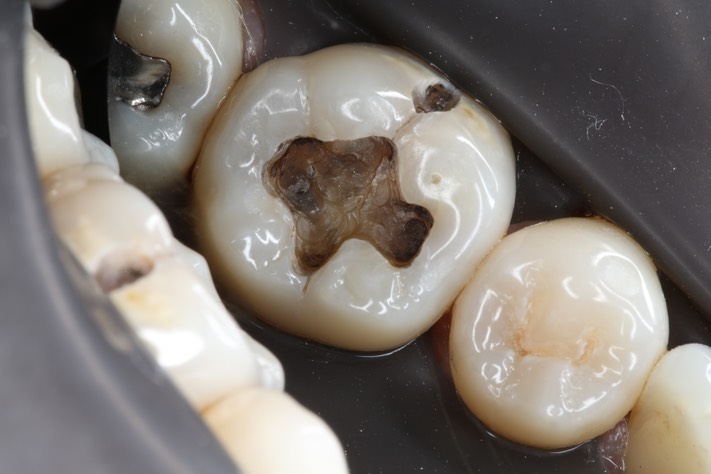 Wes Sato #30 amalgam removal