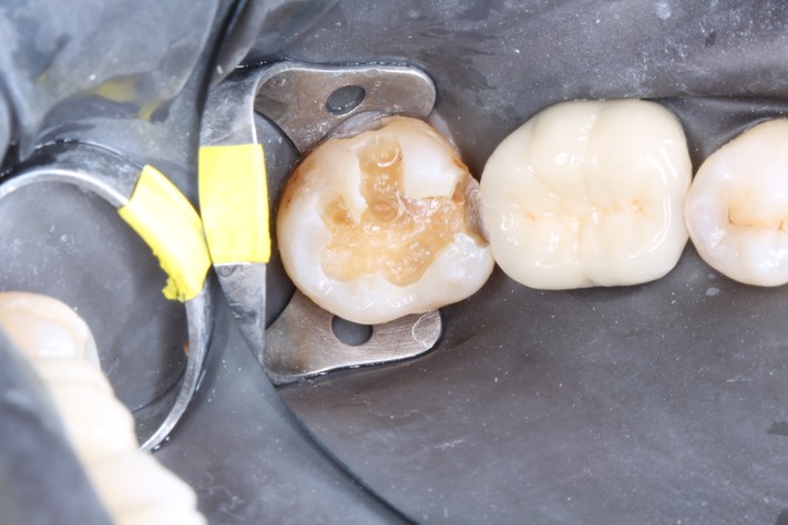 Scott Kanamori #31 comp removal