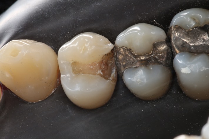 Wayne Chin #5 amalgam removal