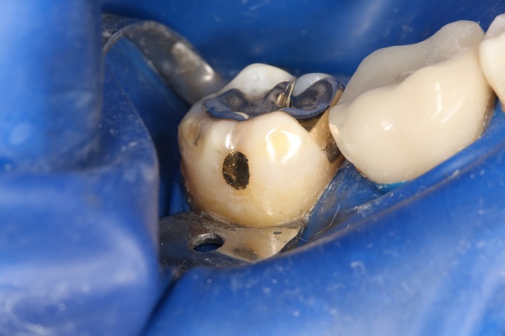 Mark Chun #31 finish buccal view