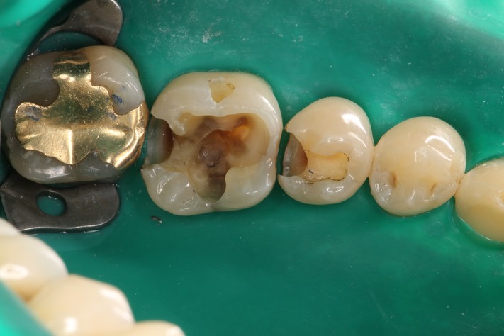 Ted Kanamori #29 - 30 caries removal