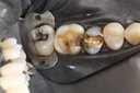 Wayne Chin #14 caries removal