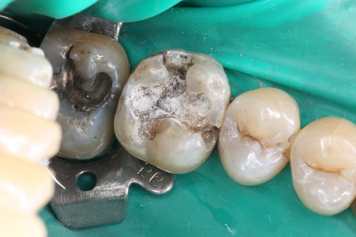 Wes Sato #14 amalgam removal