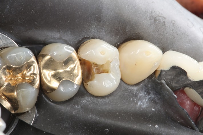 Scott Kanamori #12 caries removal