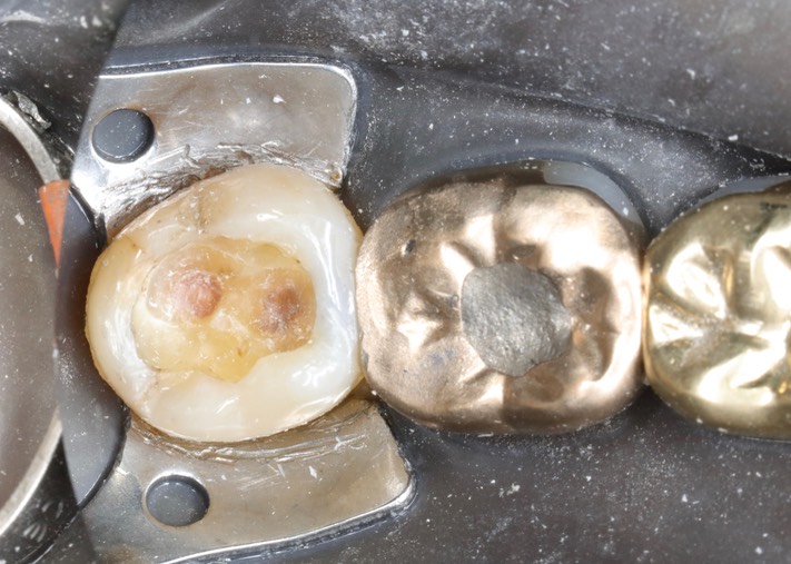 Alan Chinn #32 caries removal