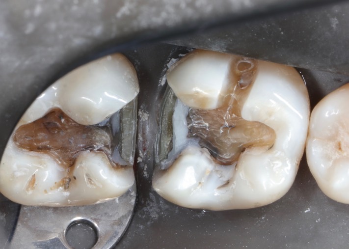 Kyle Chock #30-31 prep 2