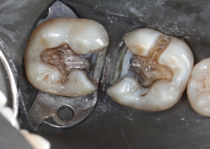 Kyle Chock #30-31 prep