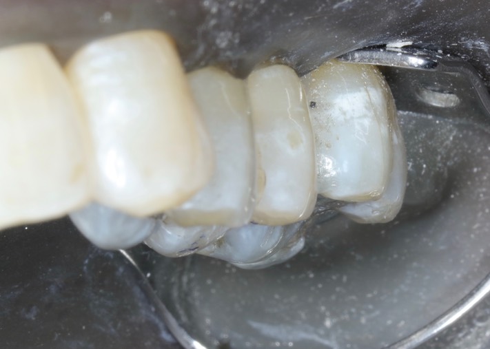 Joe Cha #13 pre-op buccal view