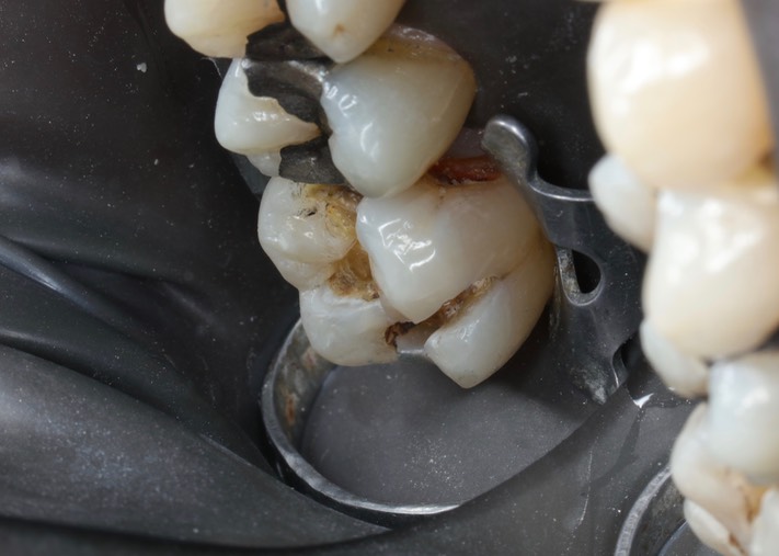 Matt Dodson #14 amalgam removal lkngual view