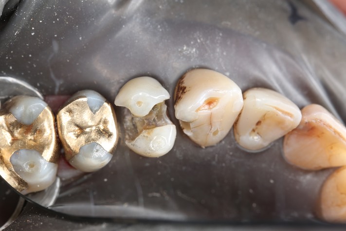 28Larry Fujioka #12-12 caries removal