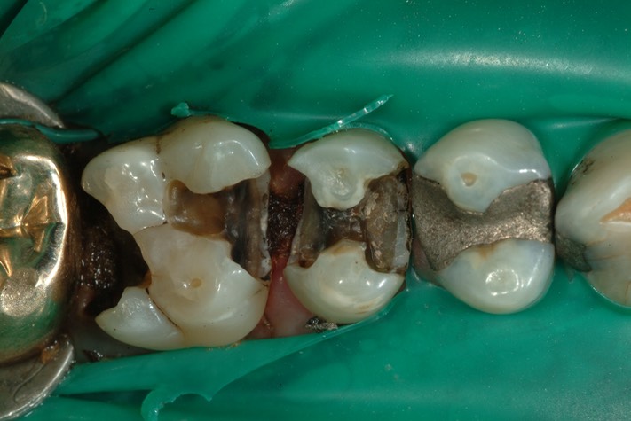 Larry Fujioka #11-12 pre-op