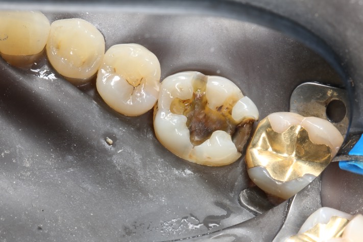 37Frank Fukuda #19 caries removal