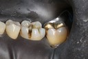 38Frank Fukuda #19 caries removal buccal