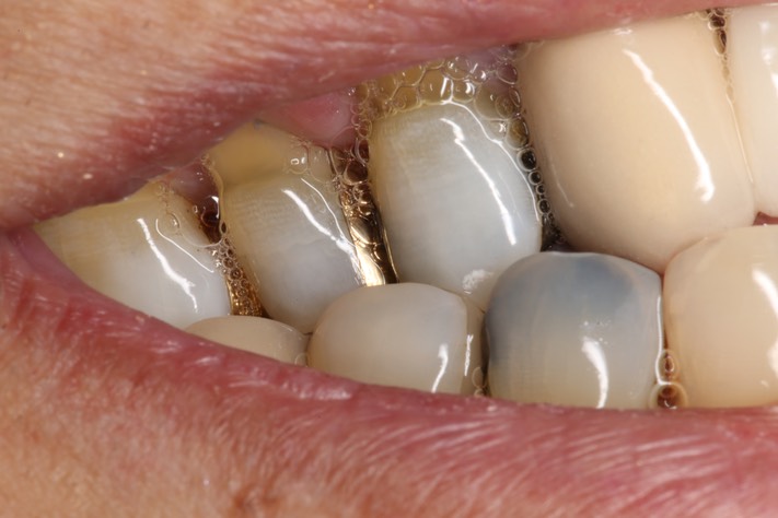 64Mendel Sato #4 cross bite