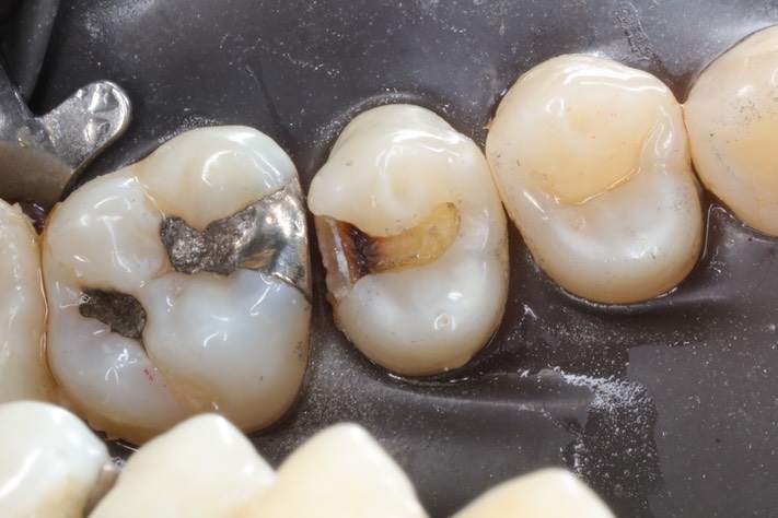 Alan Chinn #13 amalgam removal