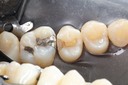 Alan Chinn #13 caries removal