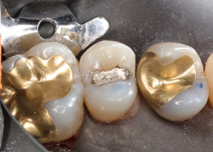 Alan Chinn #13 pre-op 