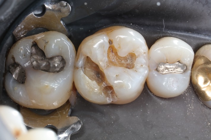 Alan Chinn #14 caries removal