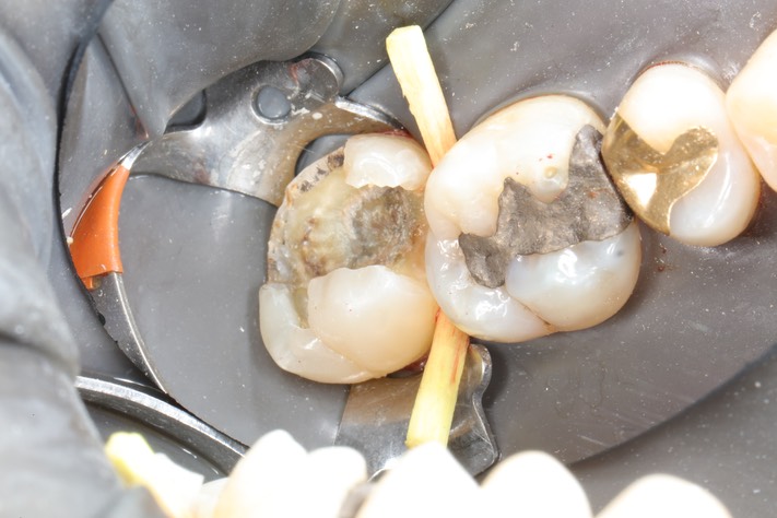 Alan Chinn #15 amalgam removal