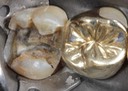 Alan Chinn #15 caries removal