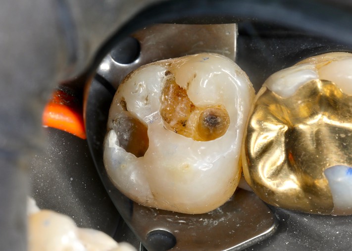 Alan Chinn #15 caries removal