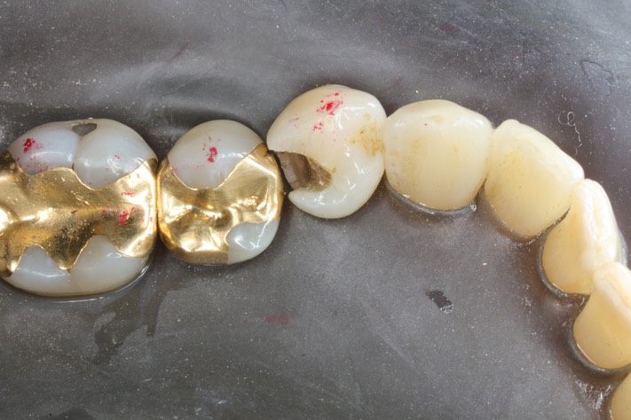 Alan Chinn #28 caries removal