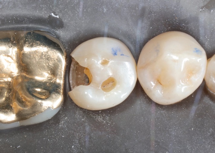 Alan Chinn #29 caries removal