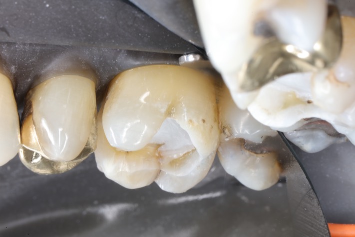 Alan Chinn #3 buccal bale