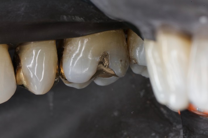 Alan Chinn #3 buccal view