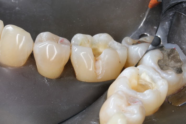 Alan Chinn #30 prep buccal view