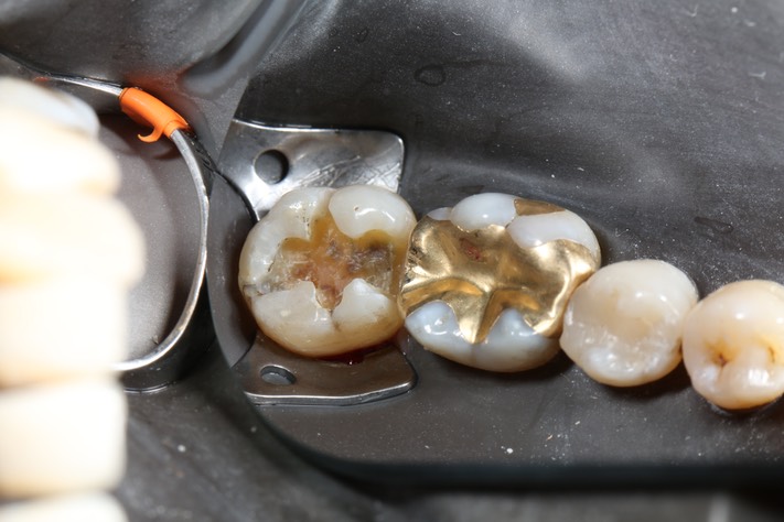 Alan Chinn #31 caries removal