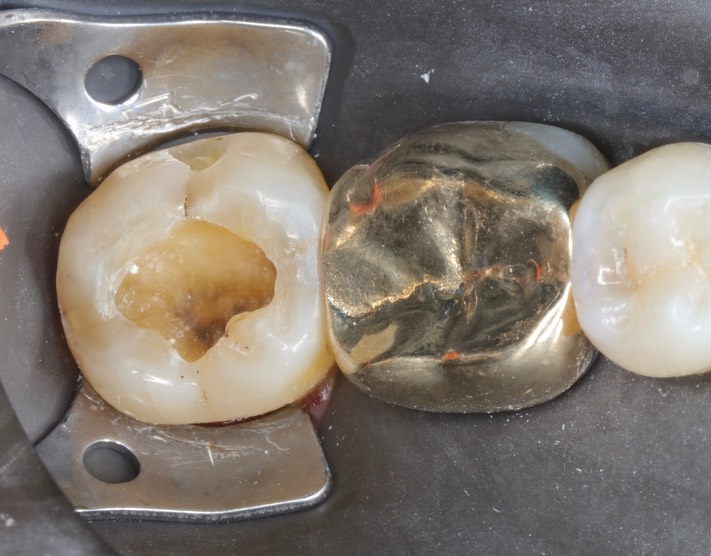 Alan Chinn #31 caries removal