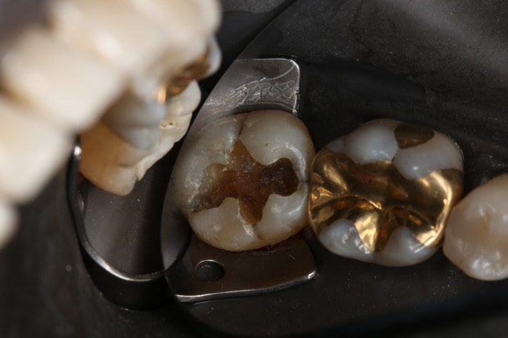 Alan Chinn #31 caries removal