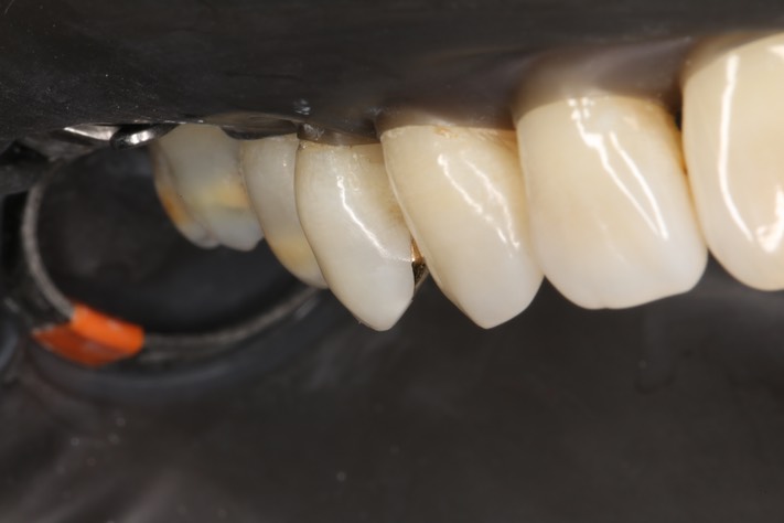 Alan Chinn #5 finish - buccal view