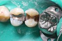 Alan Tamashiro #4 caries removal