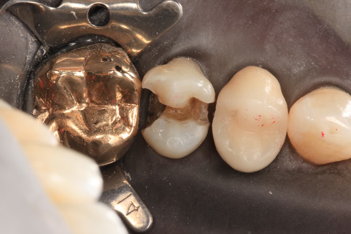 Alan Chinn #13 caries removal 2