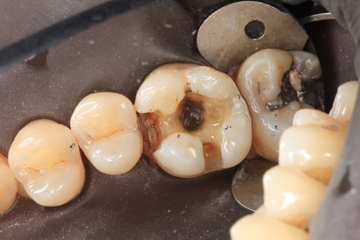 Alan Tamashiro #3 amalgam removal