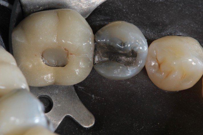 Brandon Yokota pre-op