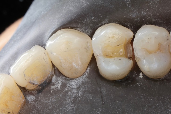 Brian Sato #12 amalgam removal