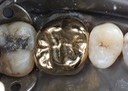 Brian Sato #14 finish occlusal