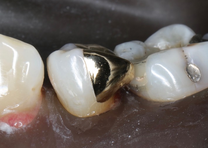 Brian Sato #20 finish - buccal view