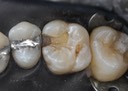 Brian Sato #3 caries removal