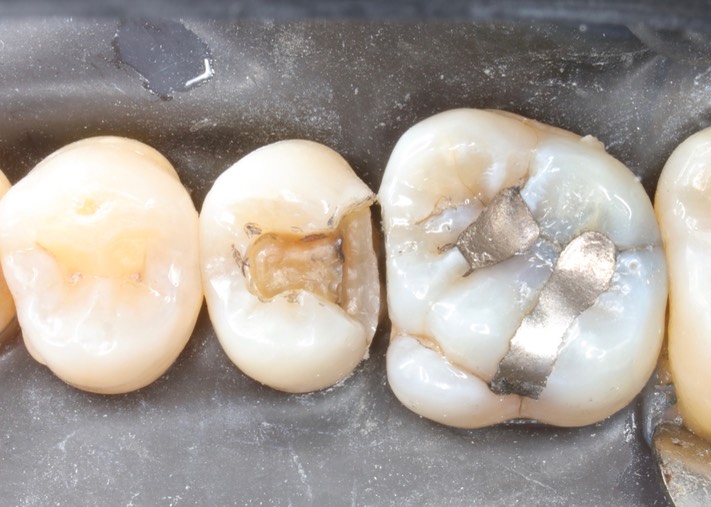 Brian Sato #4 caries removal