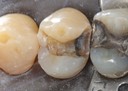 Brian Sato #5 caries removal