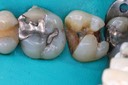 Bryan Sato #2 amalgam removal