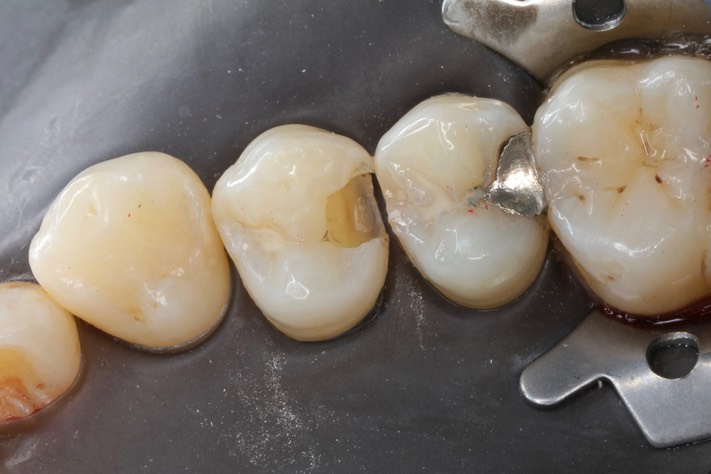 Bryan Sato #5 amalgam removal