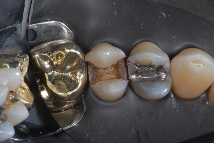 Carla Fukumoto #13 amalgam removal